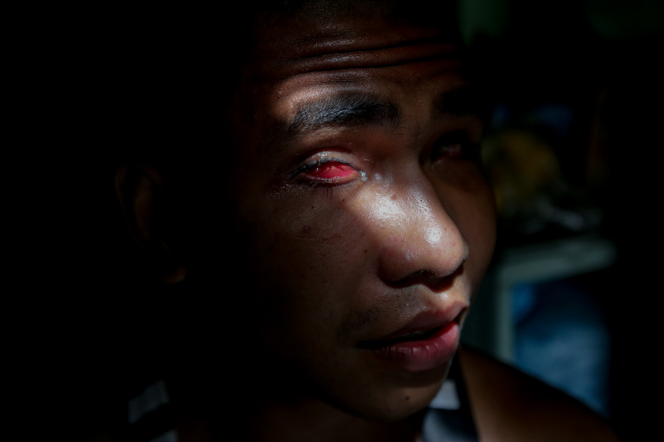 Je uses his face mask to cover the rest of his face most of the time. The sunlight and dust outside hurt his eyes and at times even cause it to bleed. “Masakit talaga sya pero kailangan ko kumilos. Dati nga, may nagtanong sa