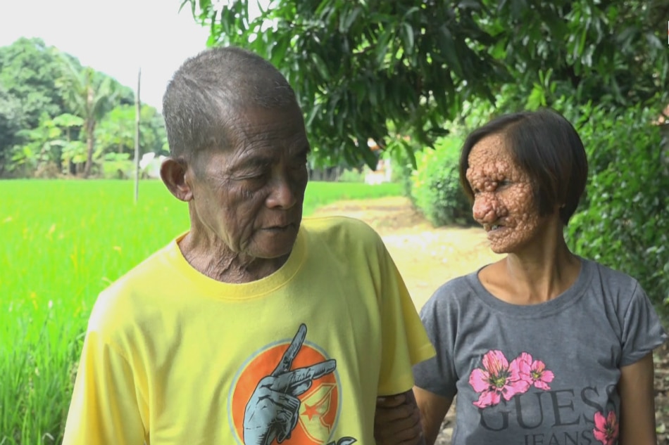 Babaeng May Kakaibang Kundisyon Sa Balat Nakahanap Ng Tunay Na Pag 7626