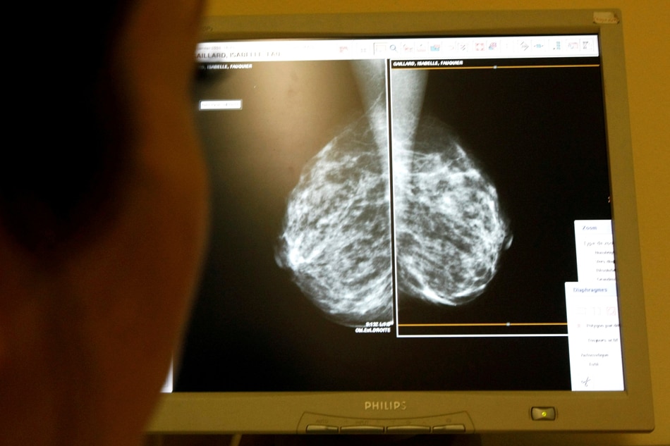 No need for chemo in many breast and lung cancers, studies show 1