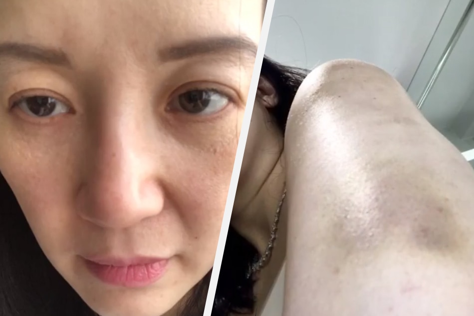 In revealing photos, Kris shows flare-ups from disease in effort to raise awareness 1