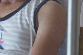 Posibleng magkaroon ng measles outbreak sa 2021: DOH