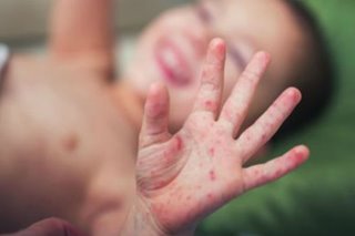 'Alarming upsurge' in measles, including in PH, has devastating impact: WHO