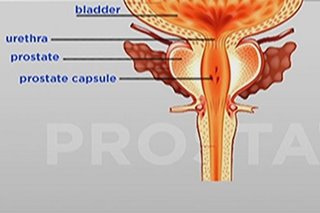 Rectal exam, ultrasound: Mga pagsusuri para maagapan ang sakit sa prostate