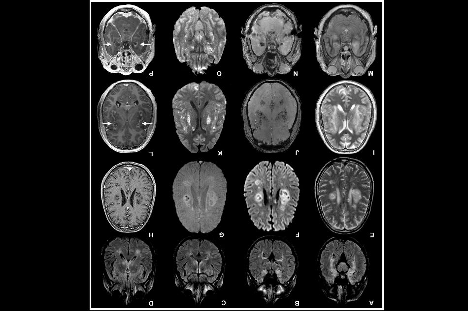An image provided by Ross W. Paterson, Rachel L. Brown, et al./Brain, Oxford University Press, brain scans of coronavirus patients from a study published in July. The new study offers the first clear evidence that in some people, the coronavirus invades brain cells, hijacking them to make copies of itself, and the virus also seems to suck up all of the oxygen nearby, starving neighboring cells to death. Ross W. Paterson, Rachel L. Brown, et al./Brain, Oxford University Press