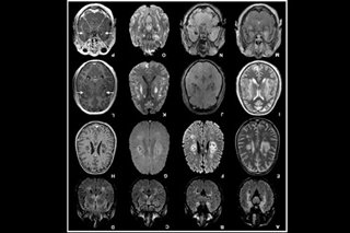 'I feel like I have dementia’: Brain fog plagues COVID-19 survivors