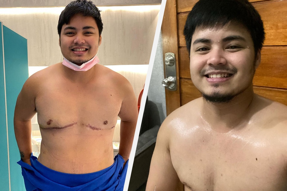 proud-trans-man-jesi-corcuera-showed-off-her-surgery-scar-filipino-news