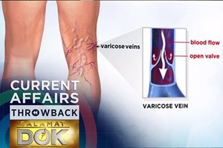 THROWBACK: What causes varicose veins and can this be treated?