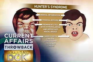THROWBACK: The role genetics play in Hunter Syndrome