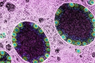 'Flurona': COVID, flu co-infections not unusual, expert says