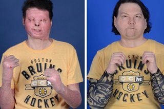 US accident victim gets first double hand and face transplant