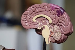 Brain problems found in 1% of hospitalized COVID patients