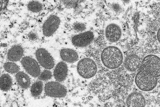 Huling kaso ng monkeypox ng bansa wala nang dagdag na pantal