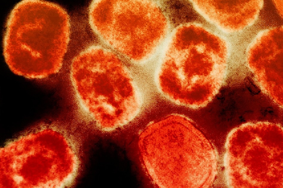  Colorized transmission electron micrograph of monkeypox virus particles (orange) cultivated and purified from cell culture. Image captured at the NIAID Integrated Research Facility (IRF) in Fort Detrick, Maryland. Credit: NIAID/file