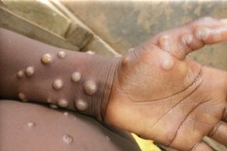 DOH: 'Premature' to close borders over monkeypox threat