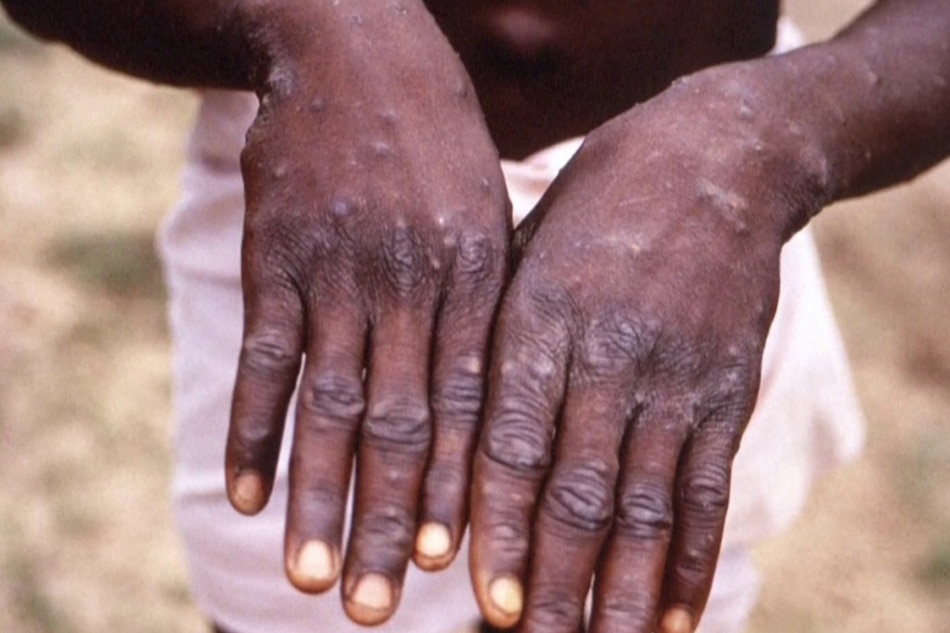 This handout photo provided by the Centers for Disease Control and Prevention was taken in 1997 during an investigation into an outbreak of monkeypox, which took place in the Democratic Republic of the Congo (DRC). Brian W.J. Mahy, Centers for Disease Control and Prevention via AFP