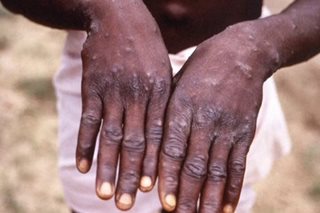 WHO nababahala sa pagkalat ng monkeypox sa ilang bansa