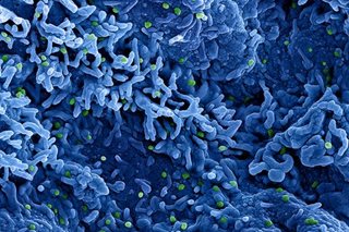 PH posibleng may local transmission na ng monkeypox: eksperto