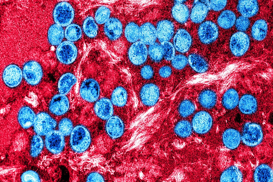 2nd US monkeypox death as virus linked to brain inflammation | ABS-CBN News