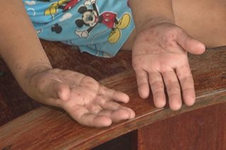 PH Red Cross has members on alert vs HFMD