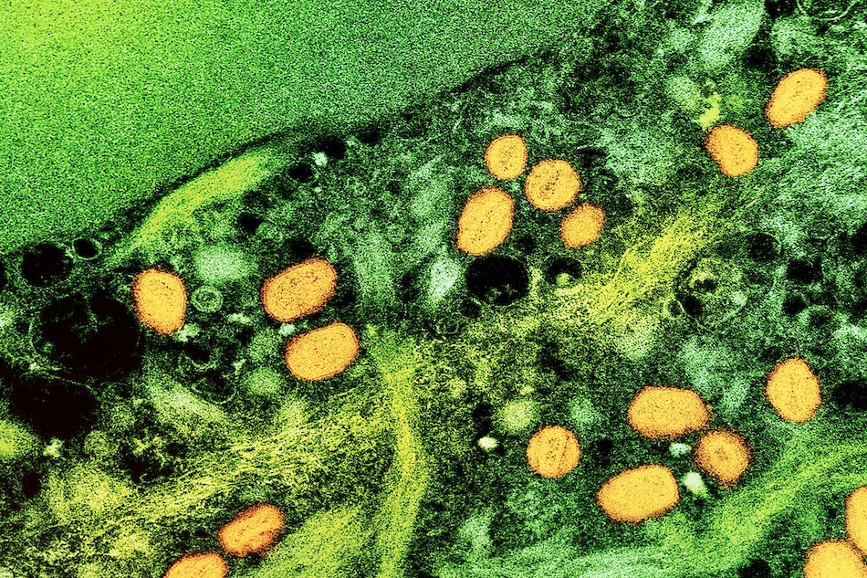 Colorized transmission electron micrograph of monkeypox virus particles (orange) cultivated and purified from cell culture. Image captured at the NIAID Integrated Research Facility (IRF) in Fort Detrick, Maryland. Credit: NIAID