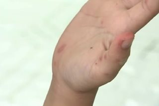 ALAMIN: Mga sintomas ng hand, foot, and mouth disease