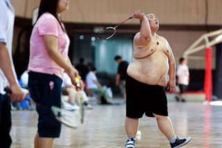 Overweight men more likely to die from prostate cancer: study