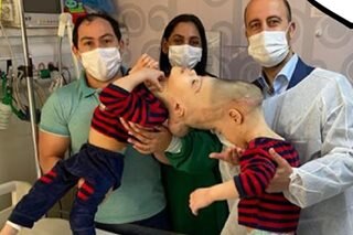 Conjoined twins separated with help of virtual reality