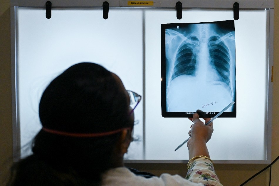 Patients Hail New Treatment For Drug Resistant TB ABS CBN News   Xray 