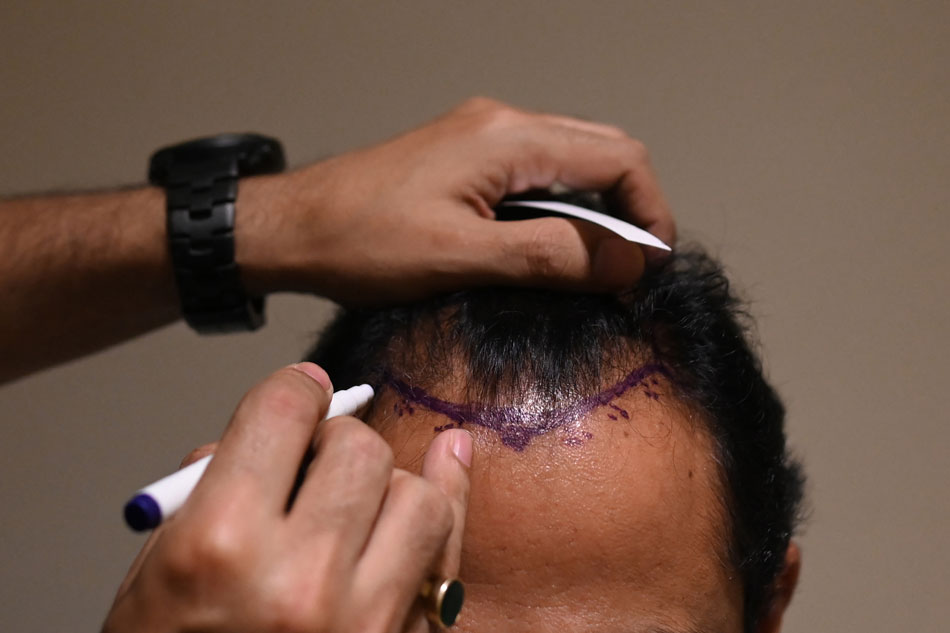  In this photograph taken on Nov. 5, 2022, Dr. Mayank Singh makes hairline markings on the scalp of a hair transplant patient at Crown clinic in New Delhi. Sajjad Hussain, AFP 