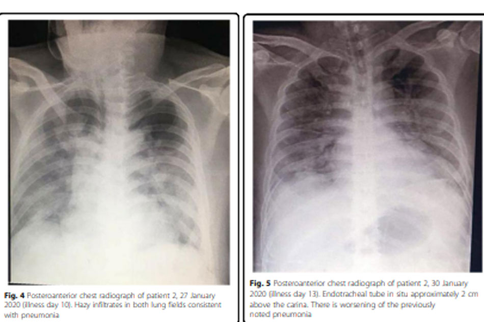 Chest x-rays of the male patient on the 10th and 13th day of illness show the quick progression of pneumonia.