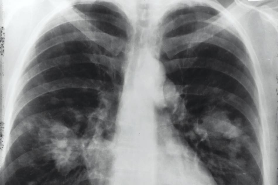 This is an x-ray image of a chest. Both sides of the lungs are visible with a growth on the left side of the lung, which could possibly be lung cancer. Photo by National Cancer Institute