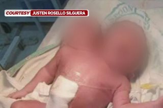 Tatay ng conjoined twins na-scam sa Tagum City