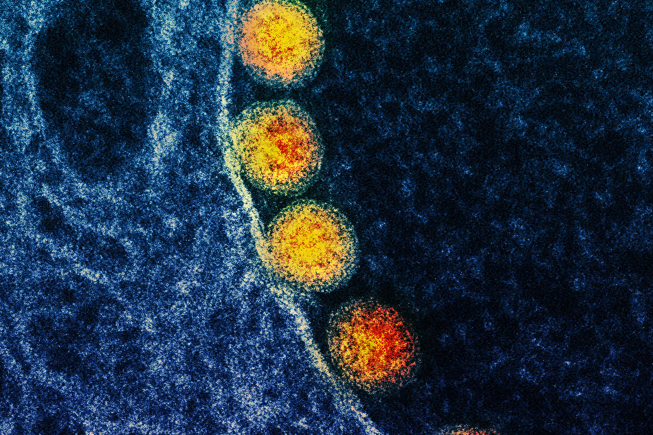 Transmission electron micrograph of SARS-CoV-2 virus particles (gold) within endosomes of a heavily infected nasal Olfactory Epithelial Cell. Image captured at the NIAID Integrated Research Facility (IRF) in Fort Detrick, Maryland. Credit: NIAID