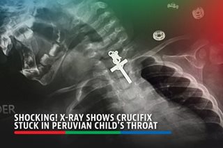 X-ray shows crucifix stuck in Peruvian child's throat