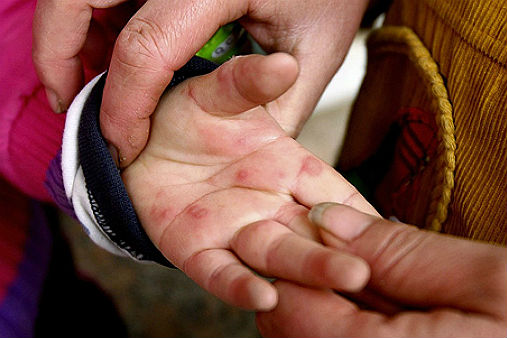 What is hand-foot-and-mouth disease? | ABS-CBN News