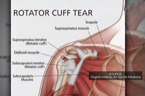 What is a torn rotator cuff injury? Doc explains ABSCBN News